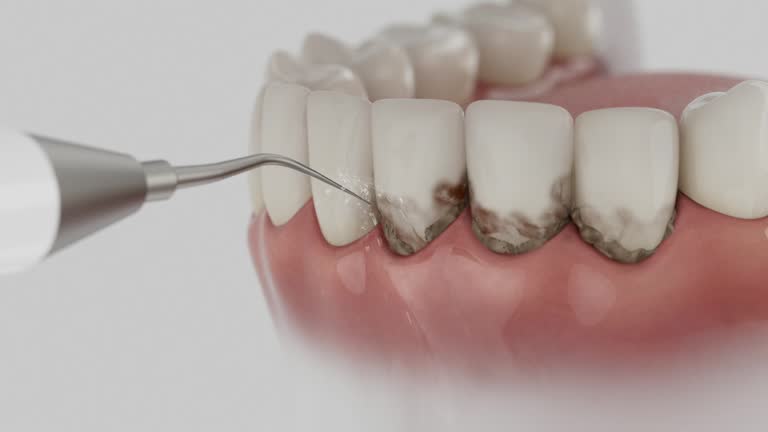 Reliable Tooth Extraction contractor in Cabazon, CA by Smile Center Dentistry